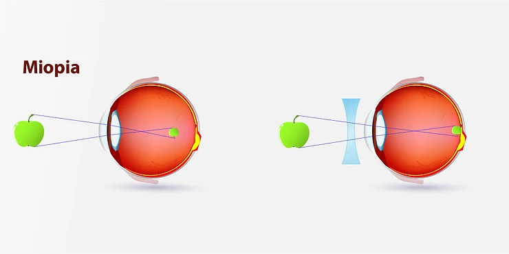 ilustração sobre a visão com miopia corrigida com uma lente