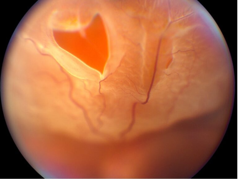 imagem no microscópio mostrando um descolamento na retina