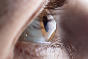 Foto de olho com a córnea em formato cônico devido ao ceratocone
