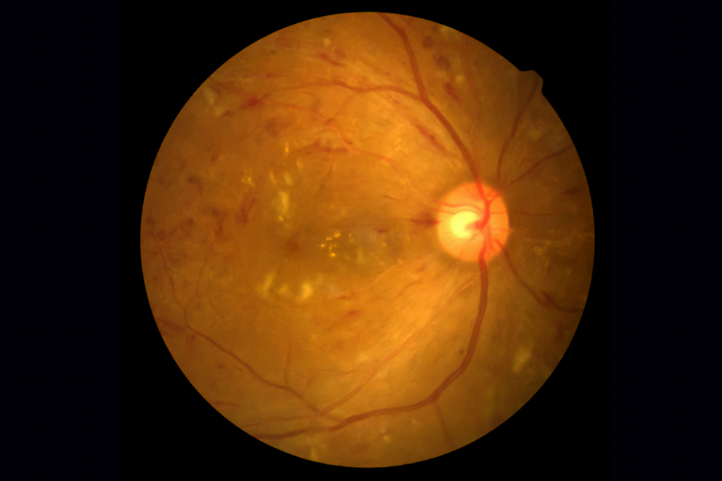 Exame de retinografia, que tira uma foto do fundo do olho, mostra um quadro de Retinopatia Diabética avançada. A imagem mostra que o olho tem muitas hemorragias e exsudatos (as manchas amareladas).