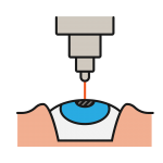 ilustração de cirurgia refrativa a laser