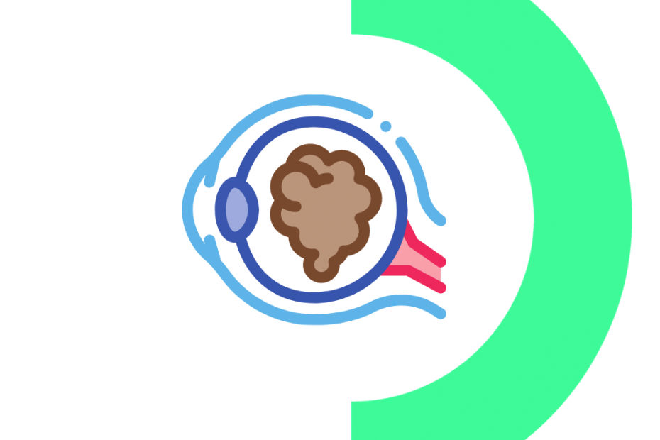 ilustração de catarata ocular com logo da dr.olho