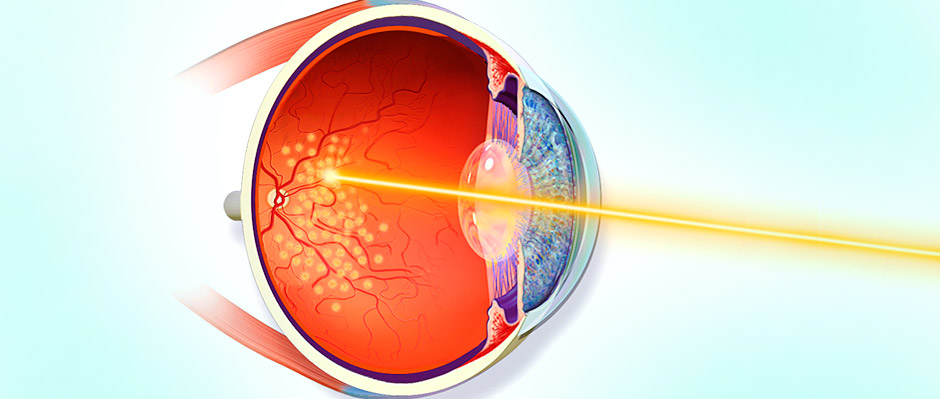 ilustração de fotocoagulação a laser na retina