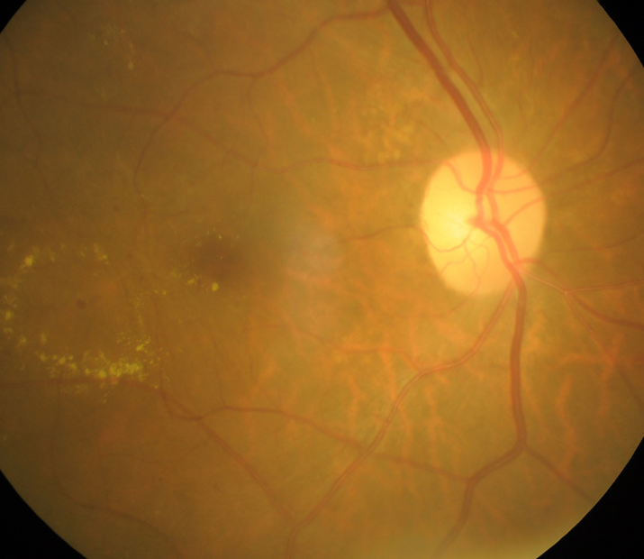 Fotografia de um fundo de olho com descolamento de retina