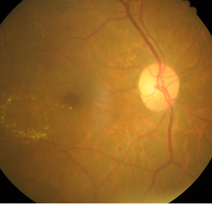 Fotografia de um fundo de olho com descolamento de retina