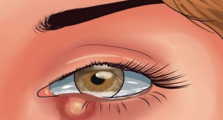 ilustração de um calázio na pálpebra
