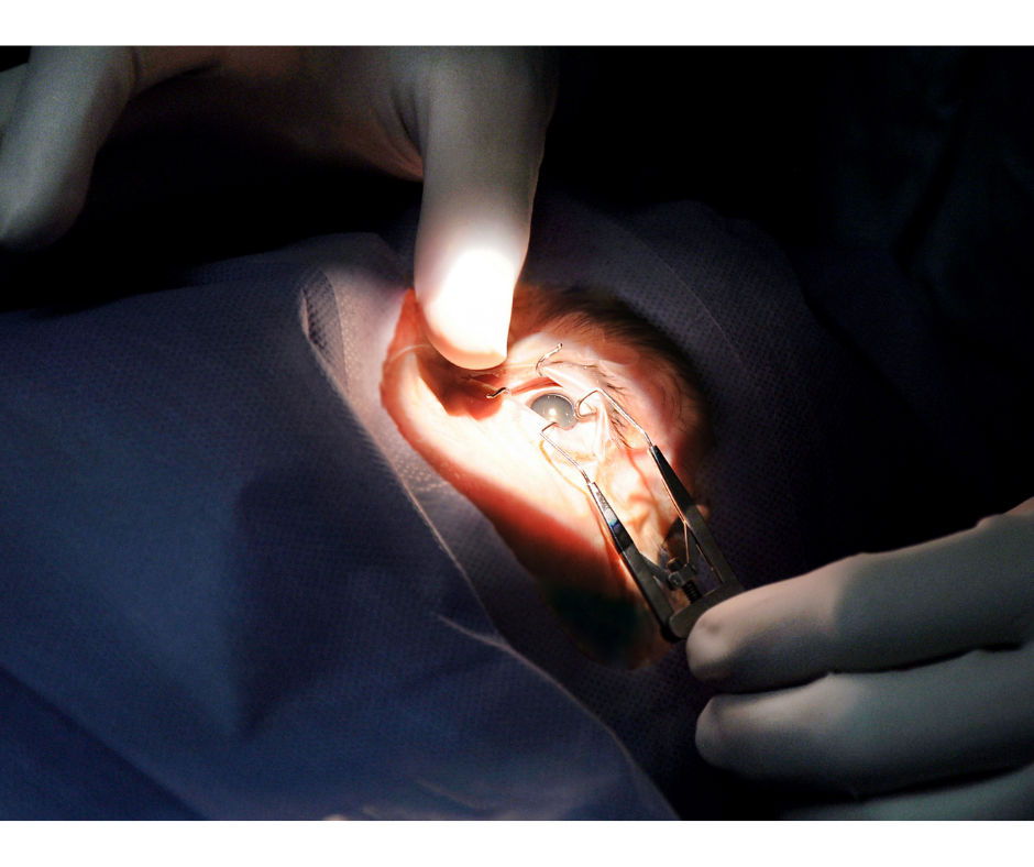 oftalmologista prepara olho para cirurgia de glaucoma a preço popular