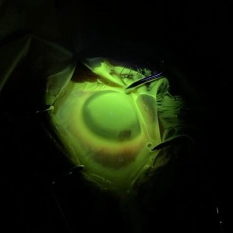 Passo da cirurgia de crosslinking em que o olho é exposto a radiação ultravioleta junto com a proteína Riboflavina e serve para estabilizar a progressão do ceratocone